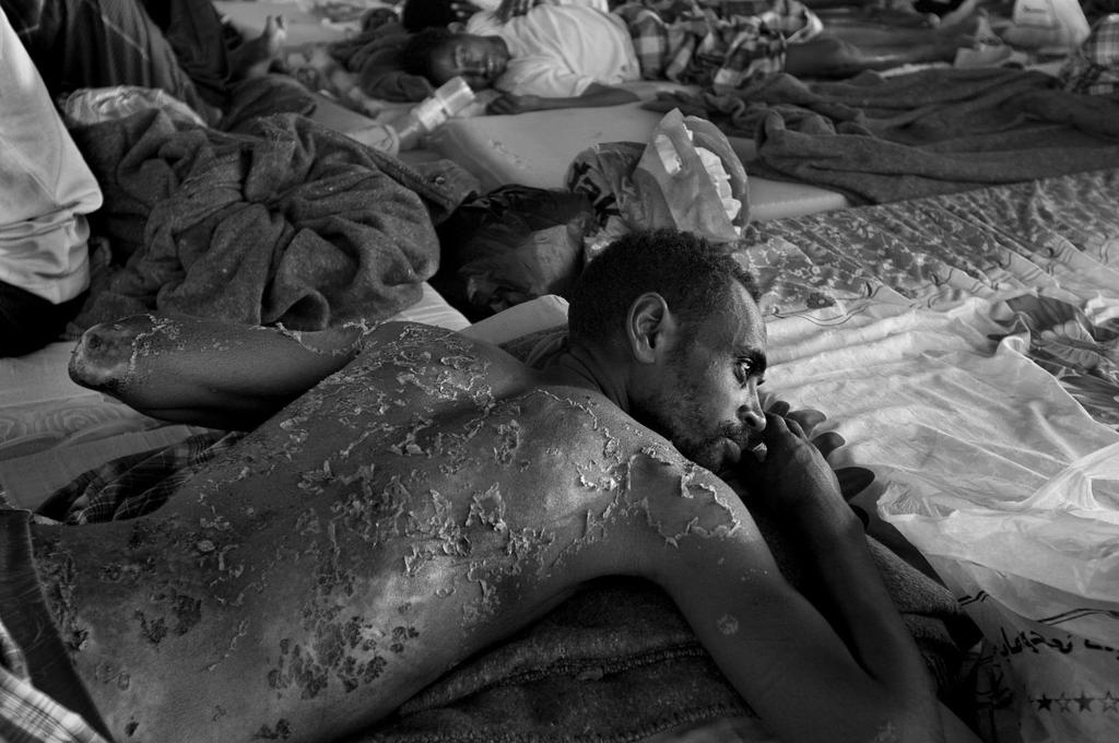 A refugee whose back was burned by sitting near the engine in the hold of a boat recuperates at a reception center in Yemen. Photo credit: E.