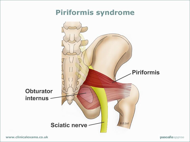 Piriformis Syndrome Ø The piriformis is a small muscle located deep to the gluteal muscles in the buttocks. It helps externally rotate and stabilize the hip.
