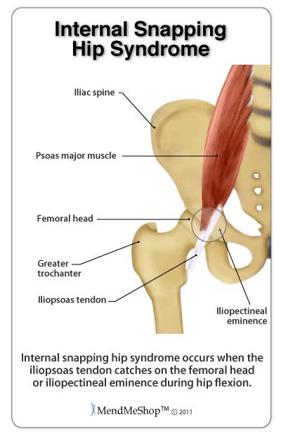 Snapping Hip Syndrome Ø One of the most common conditions dancers experience.