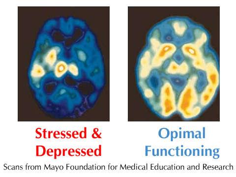 MRI of stressed/depressed brain blue indicates