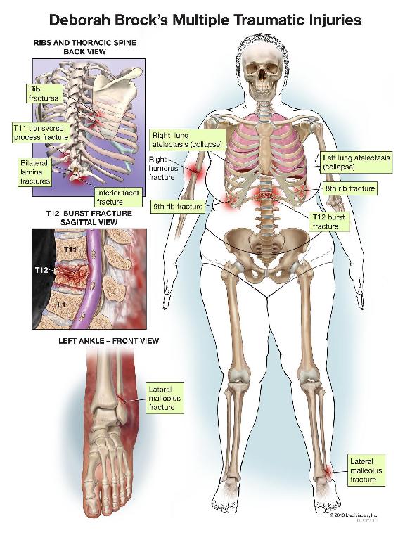 fracture, collapsed lungs, lateral malleolus fracture, and a right humerus fracture.