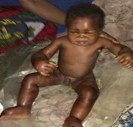 CAR children suffering from malnutrition, severe cases of marasmus and kwashiorkor,