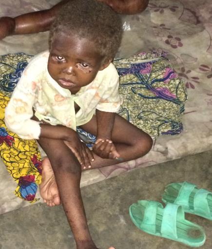 CAR child suffering from severe malnutrition, Kwashiorkor disease, Moualé, August