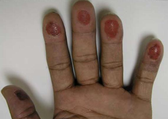 Fingerprint Alteration Mutilated fingertips