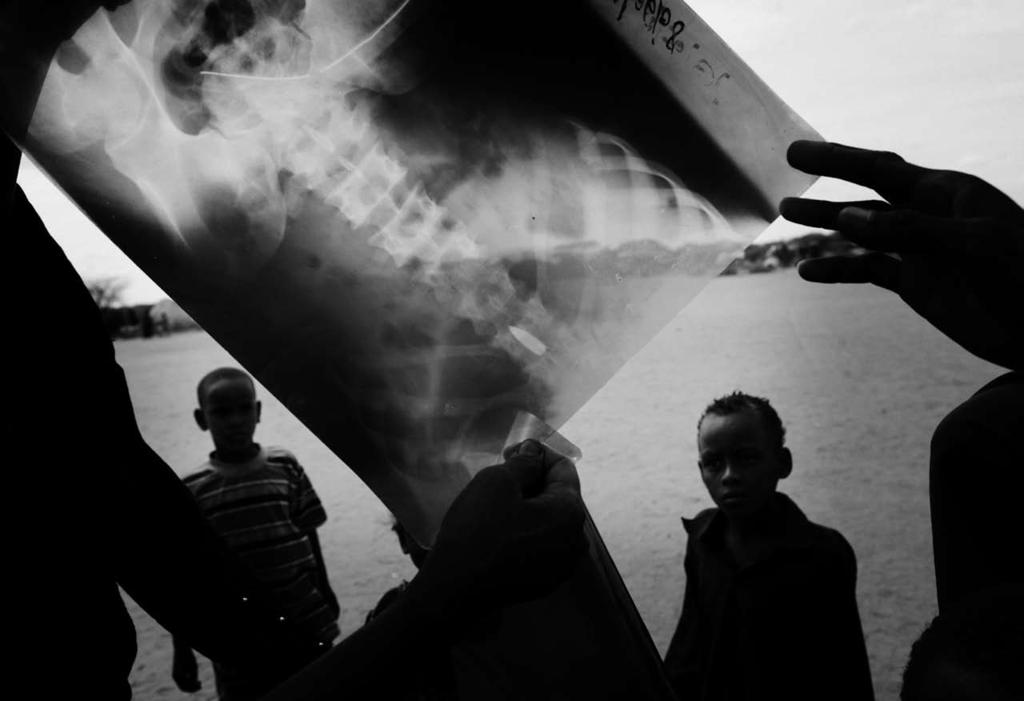 A mother in a Dadaab refugee camp holds an x-ray revealing where a bullet lodged in her son s spine.