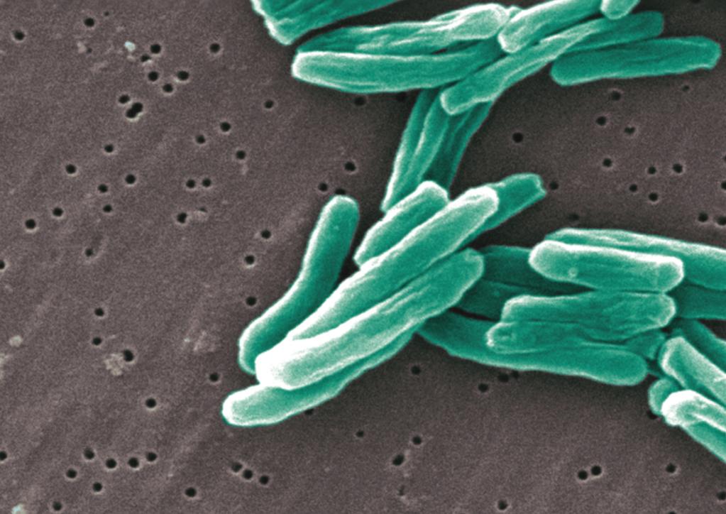 TUBERCULOSIS IN AUSTRIA TB