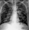 Overseas TB Screening of Immigrants and Refugees, 1991 Algorithm Inactive TB Chest radiograph > 15 years old No TB Class B2 Active TB AFB sputum smears (3) All (-) (at least one +) Noninfectious TB