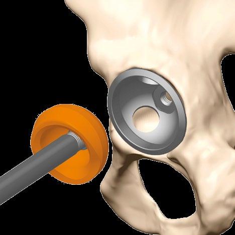 Surgical technique Acetabular Reaming The true bottom of the acetabulum is exposed by initially reaming with a small-sized reamer.