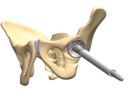 SURGICAL TECHNIQUE Please expose the hip joint completely. Resect the articular capsule and the labrum acetabulare. Dissect the bony rim of the acetabulum, if possible, completely.