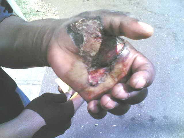 Photo 3: this man had a cobbler s needle repeatedly pushed through his hand by ZANU youth militia in Chiweshe.