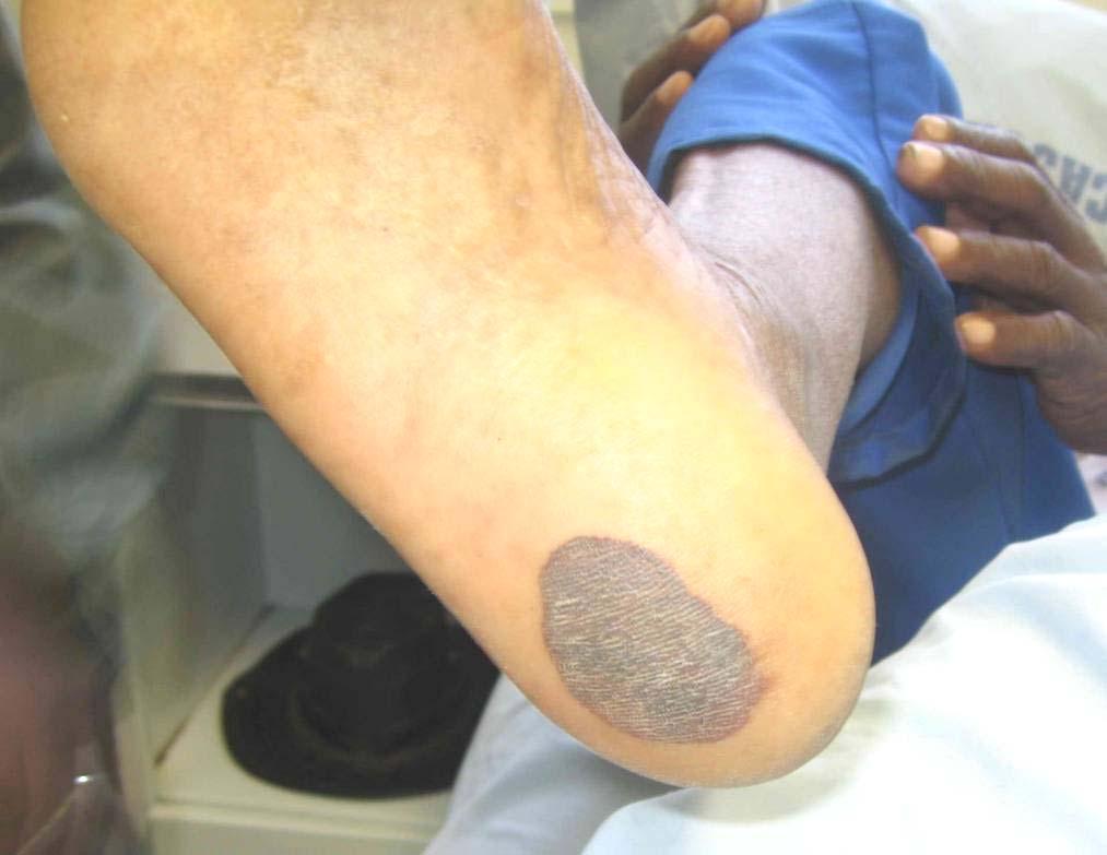 (photo June 2008) Photo 8: falanga injury: sole of foot that
