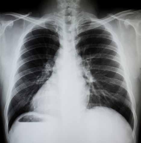 Insurers lose appeal on Scottish Pleural Plaques Act The Inner House of the Court of Session has refused the appeal of a group of insurers operating in Scotland against the rejection of their