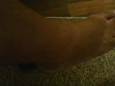 Picture of the right swelled ankle Picture of the same ankle after Medical taken on 08/24/2013.
