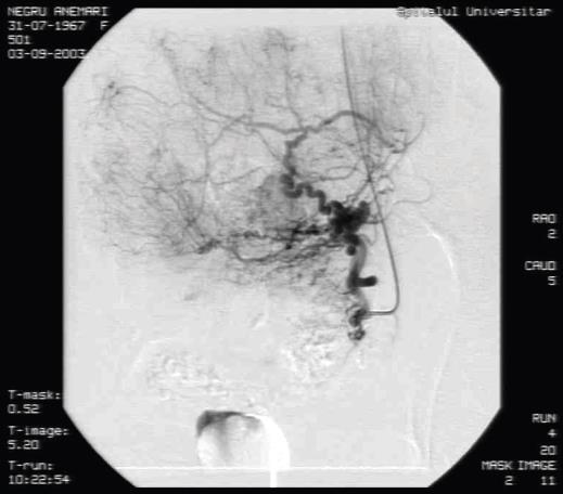 July 2015 Uterine artery embolization implies the injection through a catheter placed in the brachial artery or femoral artery of small particles aimed to obstruct the vessels that supply the uterine