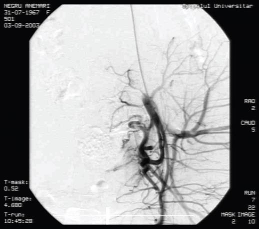 Uterine artery embolization of a voluminous leiomyoma (intra-procedural aspect) The symptoms associated to UAE appeared immediately after embolization and intensified in the first 6 hours, gradually