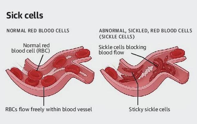 26 acute sickle cell anaemia cases detected in Attappady Among the Kurumba, Irula, and Muduka tribal communities in the region, many cases of the disorder are not getting reported.